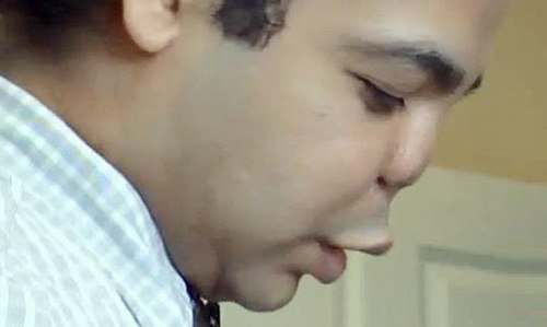 Điểm mặt những sự cố biến dạng vì phẫu thuật thẩm mỹ 2 Điểm mặt những sự cố biến dạng vì phẫu thuật thẩm mỹ 2