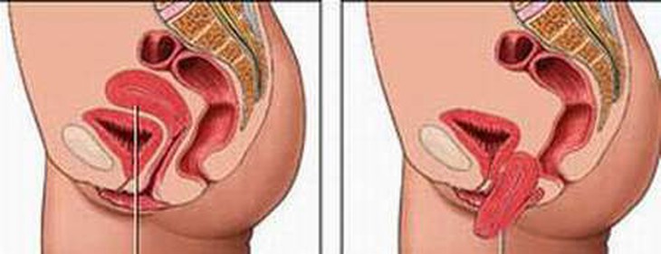 Phụ nữ đau khi giao hợp: Khi nào cần khám? 3
