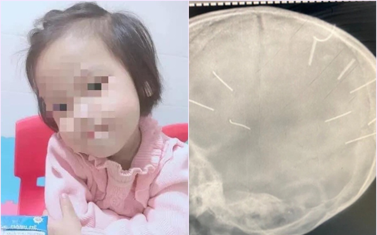 vụ bé gái 3 tuổi bị đóng đinh vào đầu:Lý do bé gái bị đóng đinh vào đầu không thể phẫu thuật