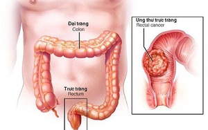 Statin có thể làm chậm quá trình ung thư di căn