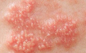 Nhận biết và phòng ngừa Herpes sinh dục