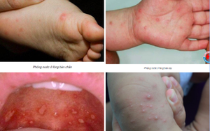 3 dấu hiệu rất sớm cảnh báo trẻ mắc tay chân miệng trở nặng