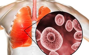 Nhiễm nấm phổi khi mắc cúm A, một người nguy kịch- Ảnh 5.