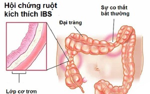 Người mắc hội chứng ruột kích thích có nên bổ sung men vi sinh?