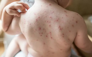 Lựa chọn thuốc điều trị thủy đậu cho trẻ