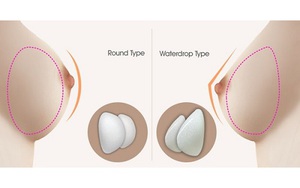 Có nên tiêm filler ngực không?