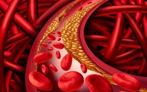 7 loại trà thảo mộc có thể giảm cholesterol xấu