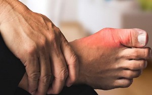 Người mắc bệnh gout chạy bộ thế nào để tránh tái phát? - Ảnh 3.