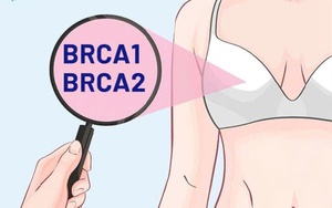 Cắt bỏ vú, buồng trứng của phụ nữ có gene ung thư vú có thể kéo dài cuộc sống