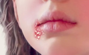 Cô gái hoảng hốt phát hiện mắc sùi mào gà sau khi ‘yêu bằng miệng’ 