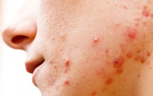 Mụn trứng cá bọc có nên nặn không?