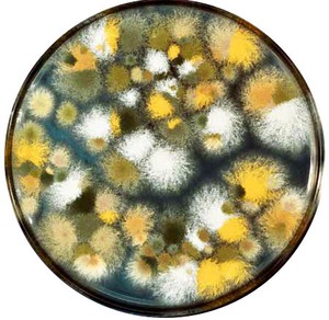 Nhiễm nấm phổi khi mắc cúm A, một người nguy kịch- Ảnh 4.