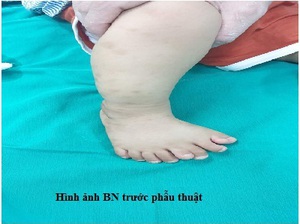 Cần làm gì khi trẻ bị dị tật thừa ngón chân ?