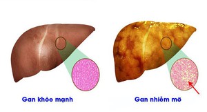 4 dấu hiệu nhận biết tổn thương gan nhiễm mỡ