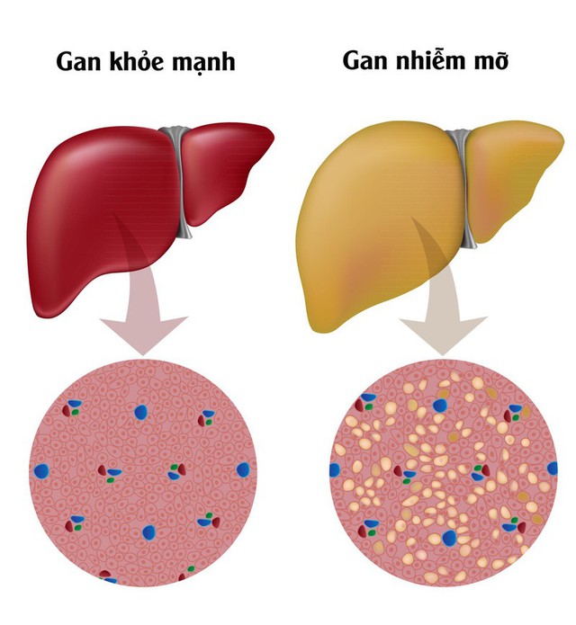 Giải pháp hỗ trợ cải thiện tình trạng gan nhiễm mỡ, máu nhiễm mỡ  - Ảnh 1.