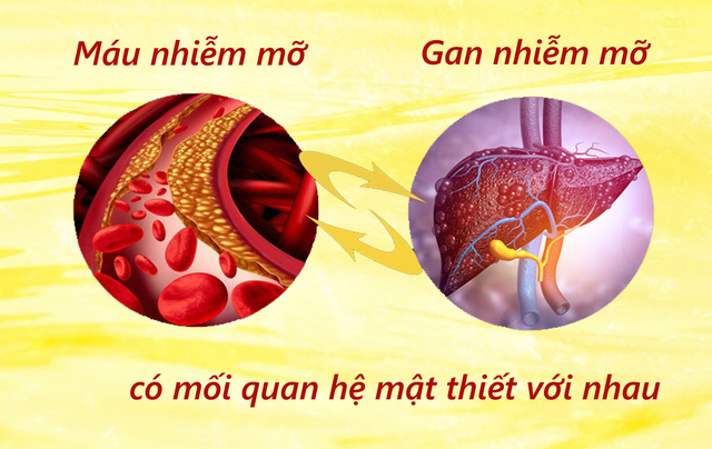 Giải pháp hỗ trợ cải thiện tình trạng gan nhiễm mỡ, máu nhiễm mỡ  - Ảnh 2.