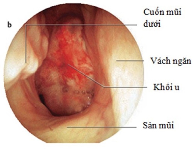 Ung thư vòm họng: Điều trị tiên lượng và phòng bệnh - Ảnh 2.