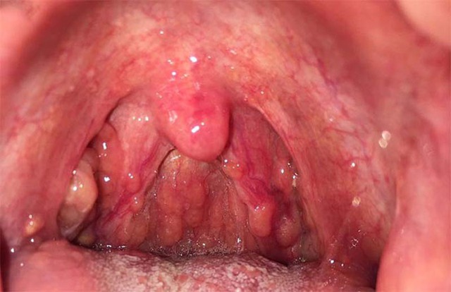 Viêm họng hạt: Nguyên nhân, triệu chứng chẩn đoán, điều trị và phòng ngừa - Ảnh 1.
