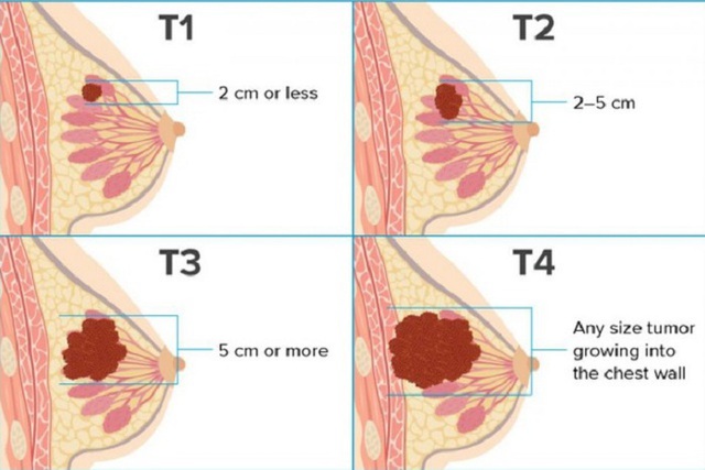 Các giai đoạn của ung thư vú và cách điều trị - Ảnh 1.