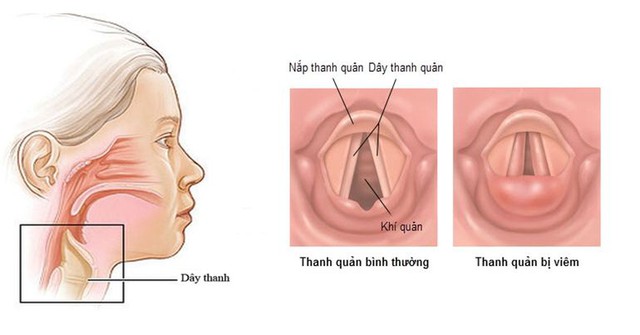 Khàn tiếng ở trẻ em: Có điều trị hay không và cần chú ý gì? - Ảnh 4.