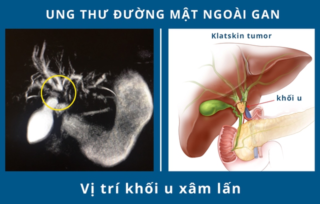 Ung thư đường mật: Triệu chứng, phân loại và nguyên nhân  gây bệnh ai cũng cần phải biết - Ảnh 3.