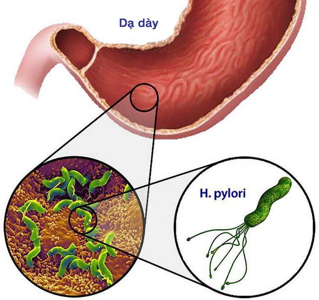 Vi khuẩn Helicobacter pylori và ung thư dạ dày - Ảnh 1.