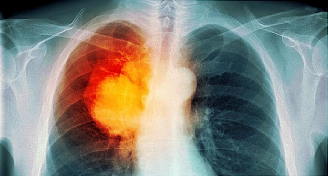 Mắc ung thư phổi sống được bao lâu và điều trị thế nào? - Ảnh 1.