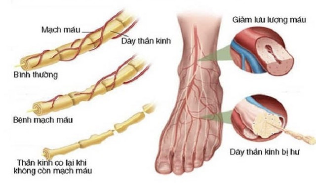 Bệnh đái tháo đường type 2 ảnh hưởng đến đời sống tình dục như thế nào? - Ảnh 3.