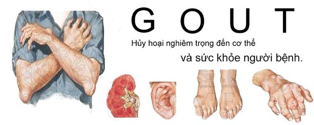 Bệnh gút (gout) và cách phòng ngừa, điều trị hiệu quả - Ảnh 3.