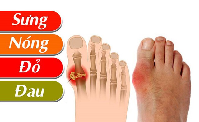 Bệnh gút (gout) và cách phòng ngừa, điều trị hiệu quả - Ảnh 5.