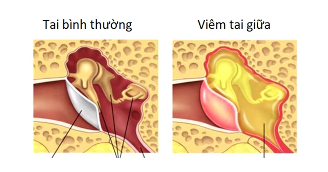 Viêm tai giữa ở trẻ em mùa lạnh: Cách phát hiện, chẩn đoán và phòng tránh như nào? - Ảnh 4.