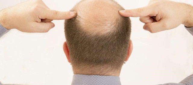 Rụng tóc nhiều là bệnh gì? Nguyên nhân và cách trị rụng tóc tại nhà - Ảnh 2.