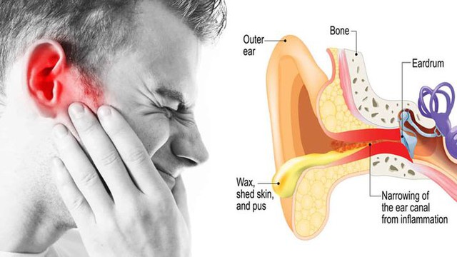 Mắc bệnh ở tai có thể gây liệt mặt và những điều cần lưu ý - Ảnh 6.