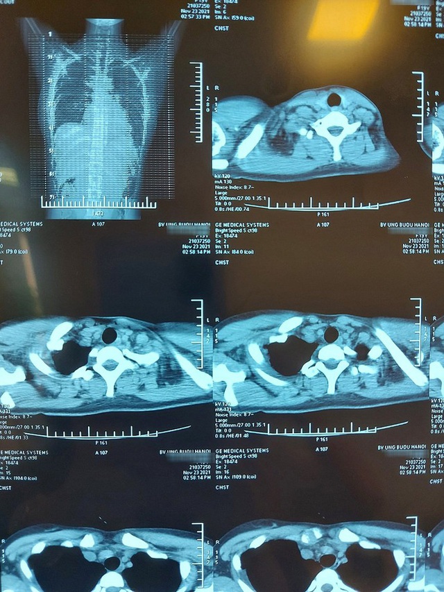 Tức ngực, cô gái 19 tuổi ở Hà Nội đi khám, phát hiện khối u quái to 20cm trong lồng ngực  - Ảnh 1.