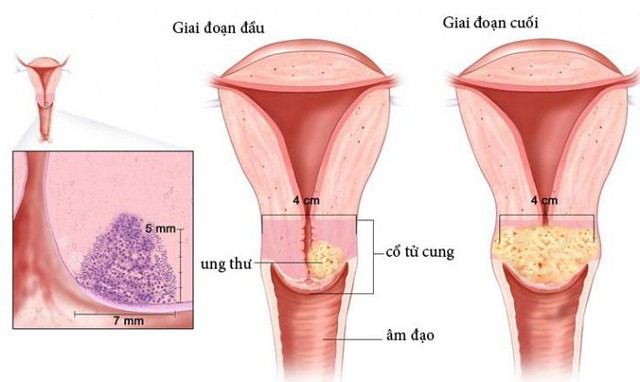 Ung thư buồng trứng: Dấu hiệu, nguyên nhân và phương pháp điều trị - Ảnh 1.