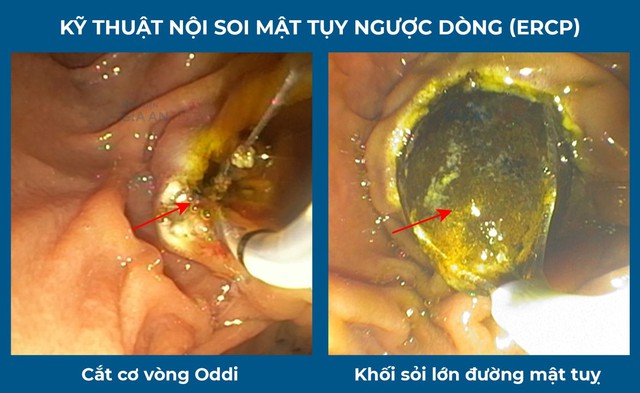 Chạy đua với thời gian cứu sống người bệnh bị sốc nhiễm trùng đường mật - Ảnh 1.