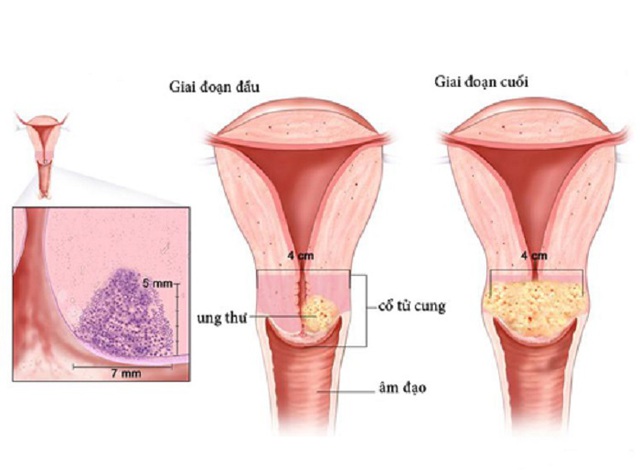 Các phương pháp sàng lọc phát hiện sớm ung thư cổ tử cung - Ảnh 2.