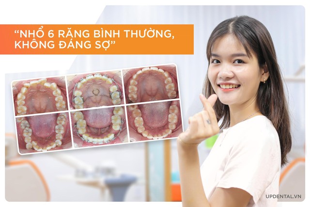 9x chia sẻ trải nghiệm niềng răng kiến tạo nụ cười - Ảnh 3.