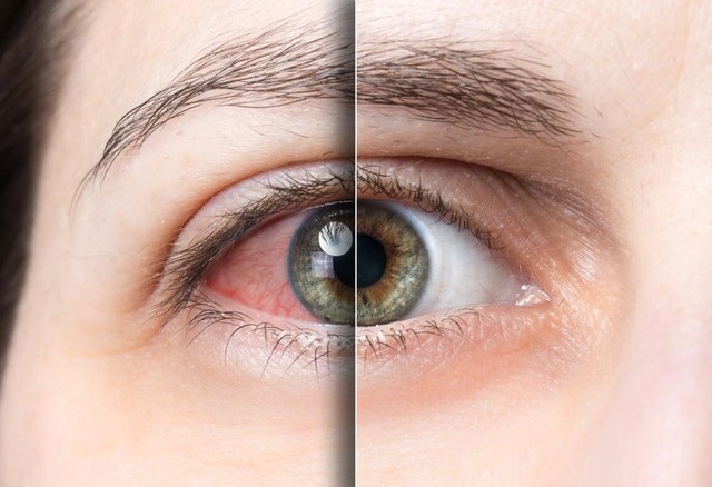 Khô mắt sau phẫu thuật tật khúc xạ, liệu có bất thường? - Ảnh 1.