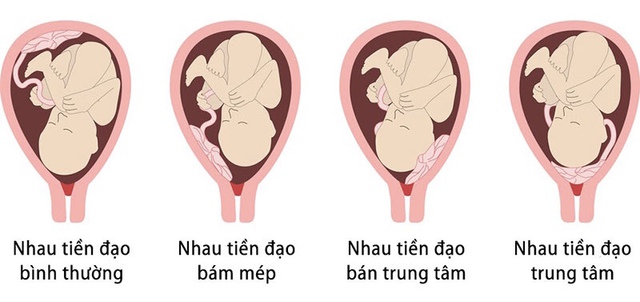 Phân loại nhau tiền đạo