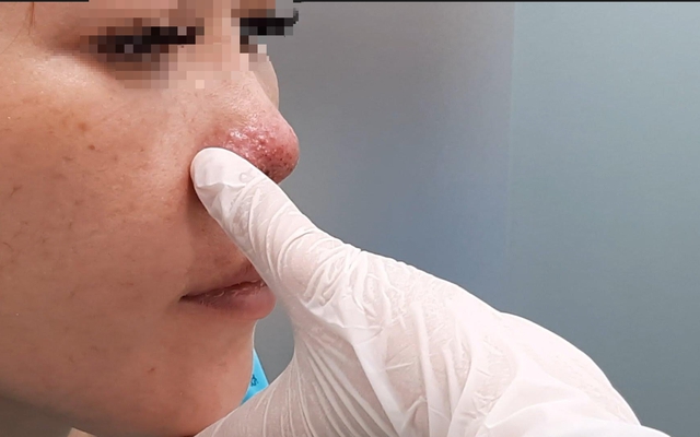 Tiêm filler nâng mũi ở spa, một phụ nữ ở TP.HCM bị biến chứng hoại tử - Ảnh 2.