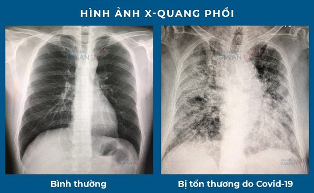 Tiếp nhận và phục hồi chức năng cho người bệnh mắc hội chứng sau dịch bệnh - Ảnh 1. Tiếp nhận và phục hồi chức năng cho người bệnh mắc hội chứng sau dịch bệnh - Ảnh 1.