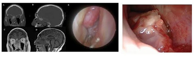 U ác tính mũi xoang: Biểu hiện, phân loại và chẩn đoán - Ảnh 2.