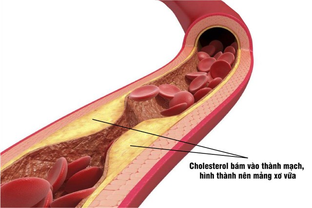 Hiểu đúng về cholesterol để phòng bệnh mỡ máu cao - Ảnh 1.