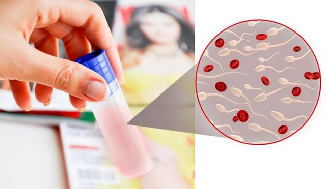 Khi tinh dịch có màu hồng, đỏ hoặc khi được xét nghiệm thấy có máu trong tinh dịch thì được gọi là xuất tinh ra máu.