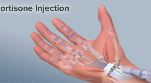 Các phương pháp điều trị hội chứng ống cổ tay - Ảnh 2.