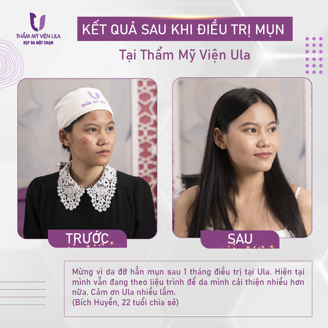 Tự tin đón Tết, &quot;xoá sạch&quot; mụn thâm cùng Thẩm mỹ viện Ula - Ảnh 3.