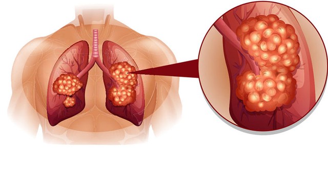 Giúp bạn đương đầu với ung thư phổi - Ảnh 1.