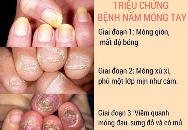 Nấm móng tay có thuốc bôi gì để trị? - Ảnh 2.