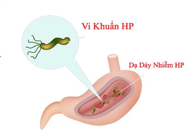 Cảnh giác với viêm loét dạ dày do vi khuẩn HP ở trẻ - Ảnh 2.
